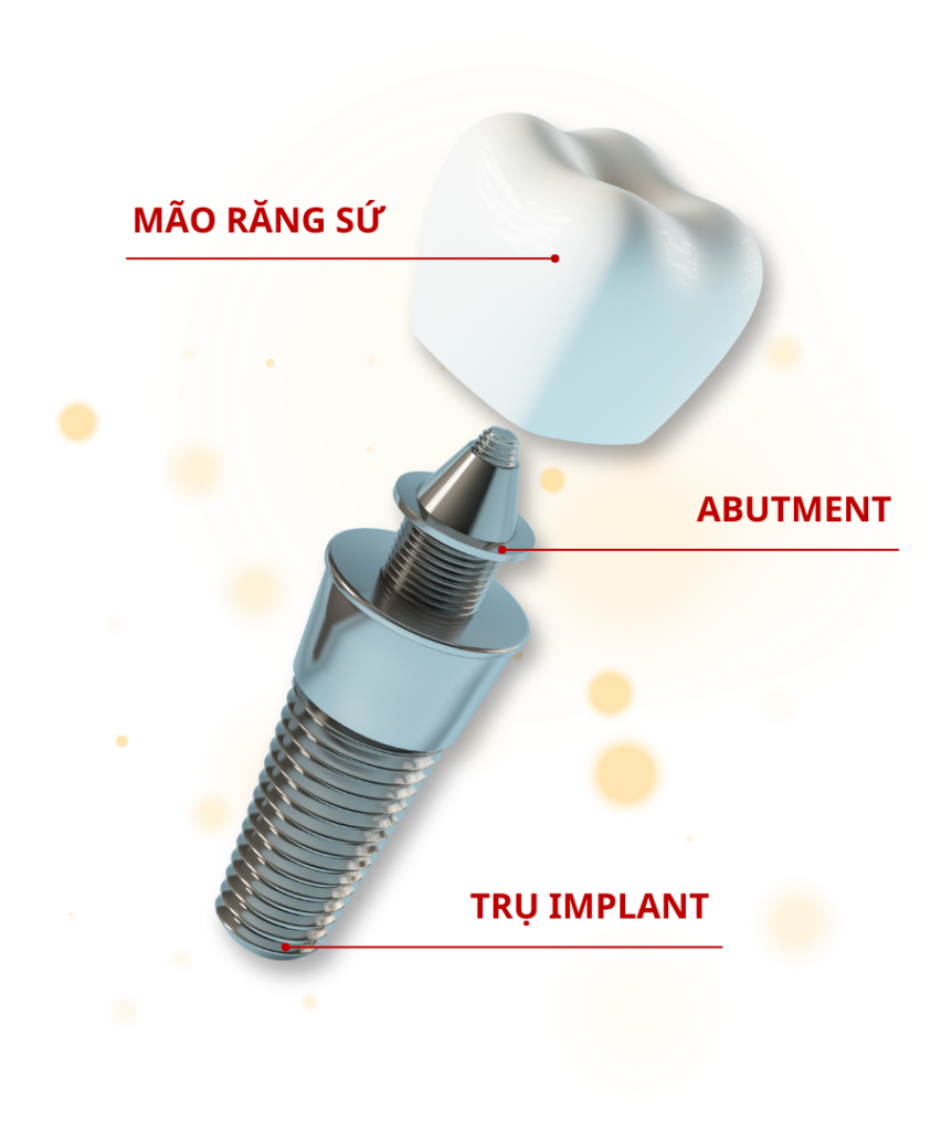 cau tao rang implant
