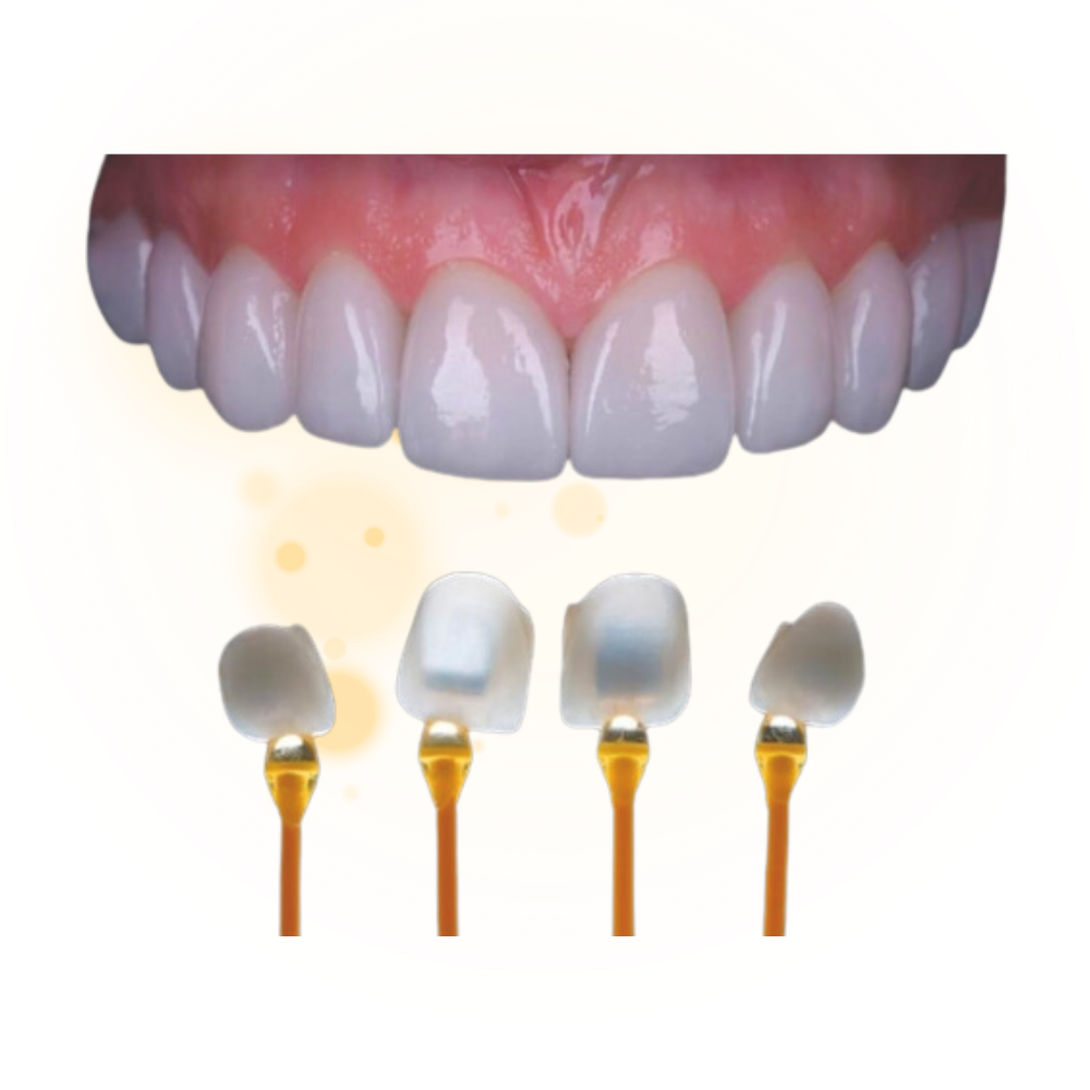 dan su veneer nha khoa viet phap smile
