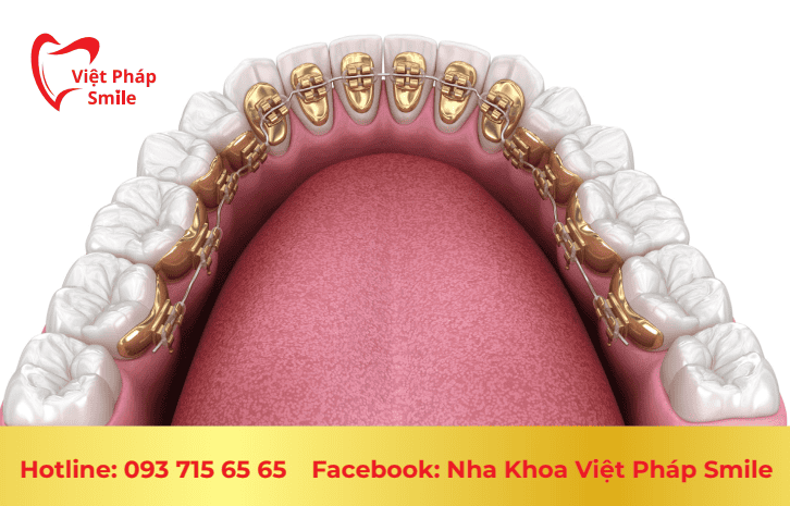 Niềng mắc cài mặt lưỡi