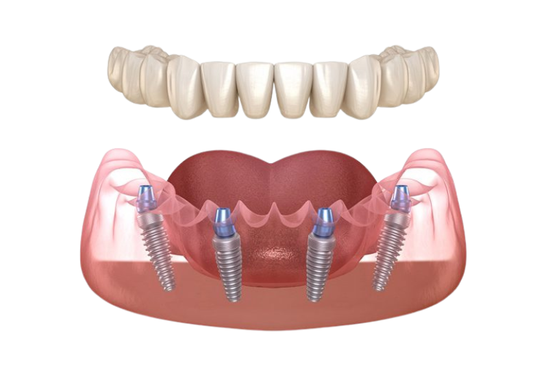 implant toan ham viet phap smile