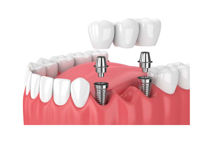 implant vai rang viet phap smile 1