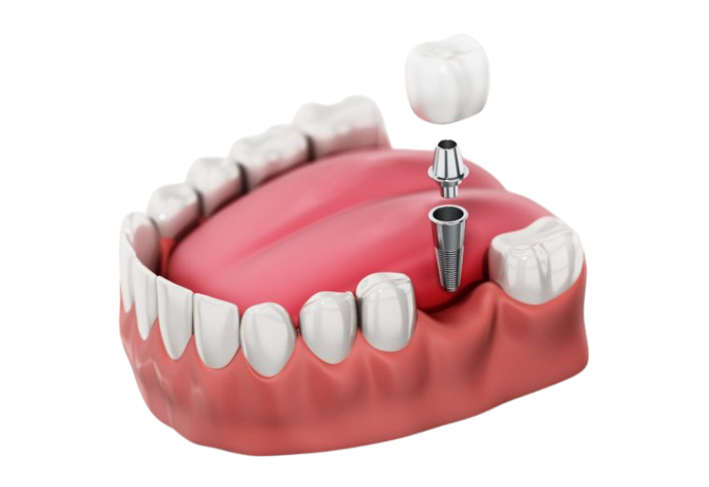 implant vai rang viet phap smile