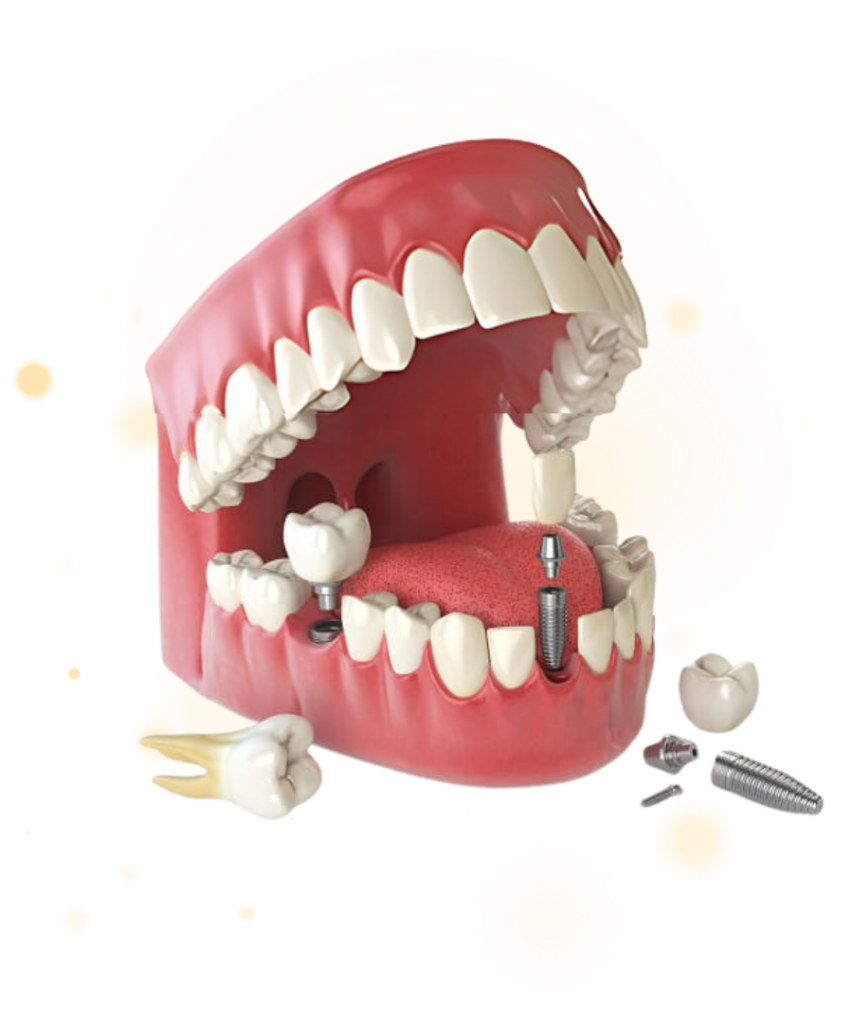 loi ich implant