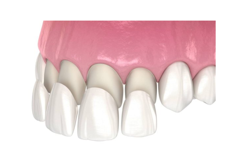 mat dan su veneer