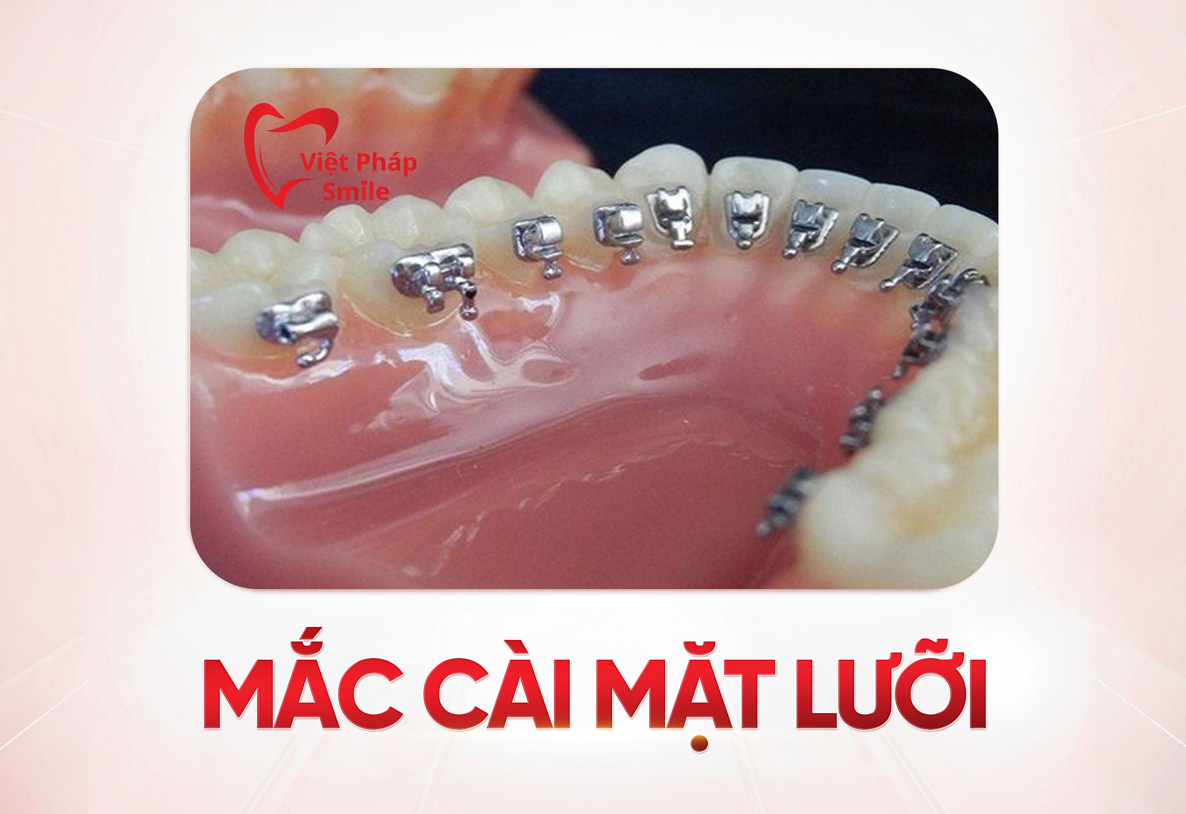 mac-cai-mat-luoi