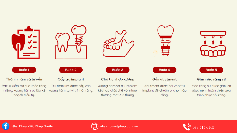 Trong-Rang-Implant-Gia-Bao-Nhieu-Tien-?