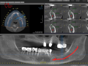 boc-mao-su-cho-rang-implant