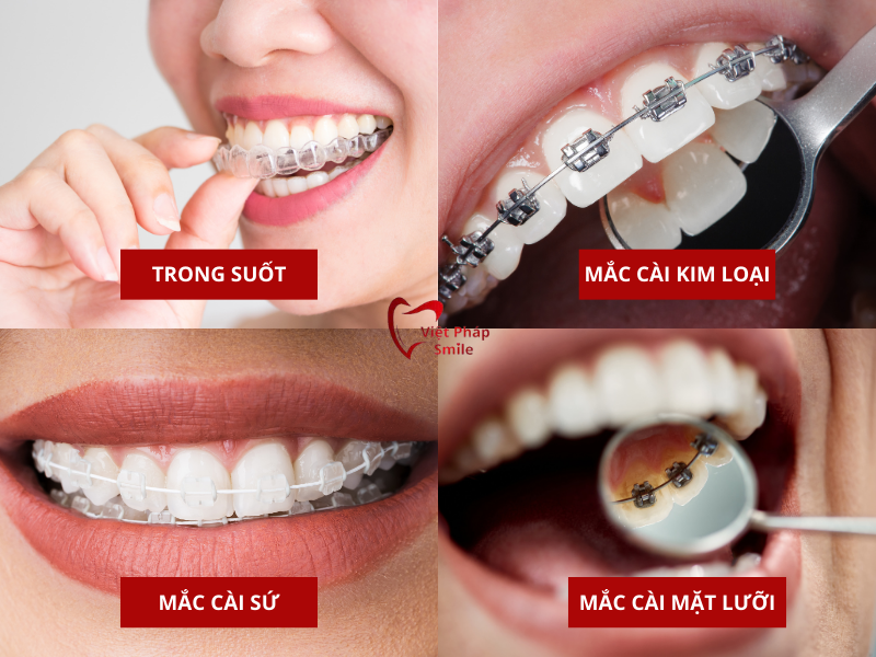 cac-phuong-phap-nieng-rang-hien-nay