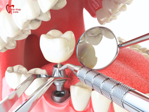 cau-tao-cua-rang-implant