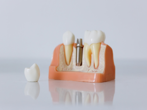 cau-truc-rang-implant