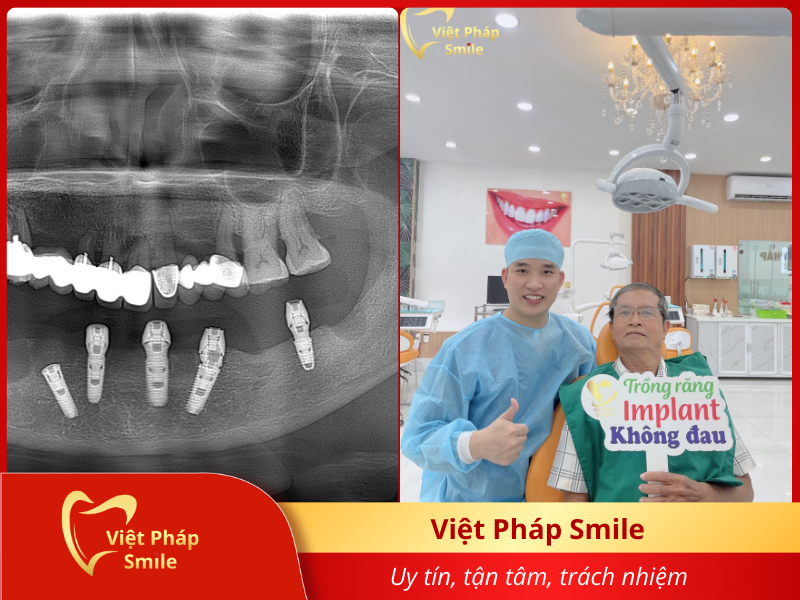 cay-ghep-implant-gia-re