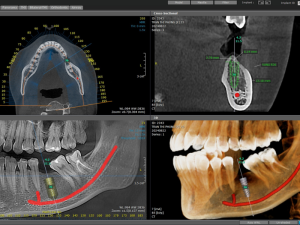 cham-soc-rang-implant