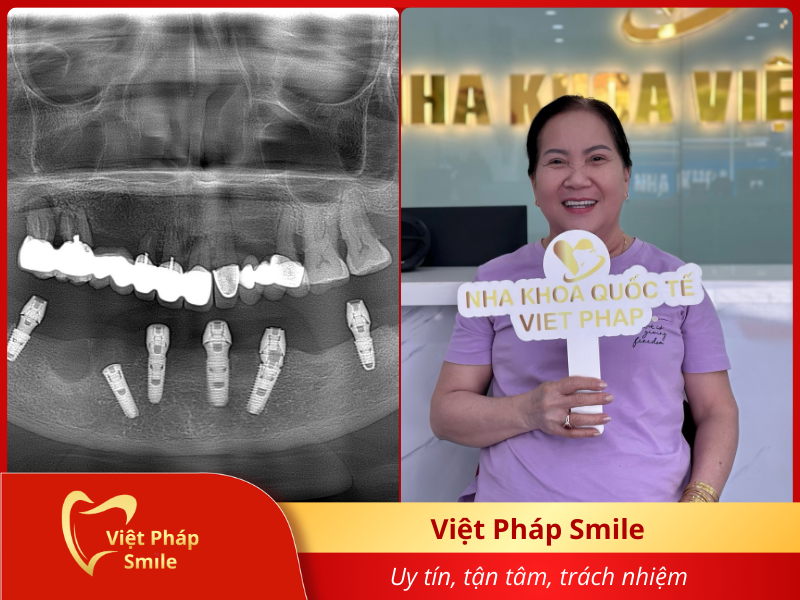 implant-1