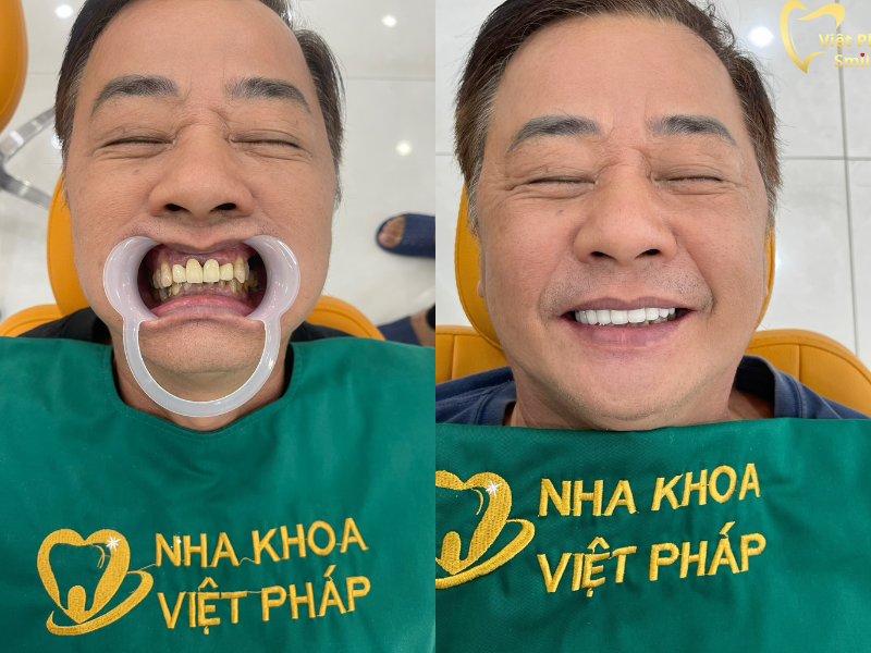 ket-qua-khi-boc-rang-su