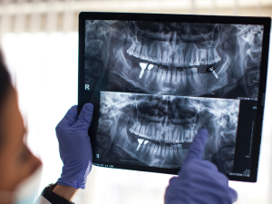 trong-rang-implant-co-bi-dao-thai-khong