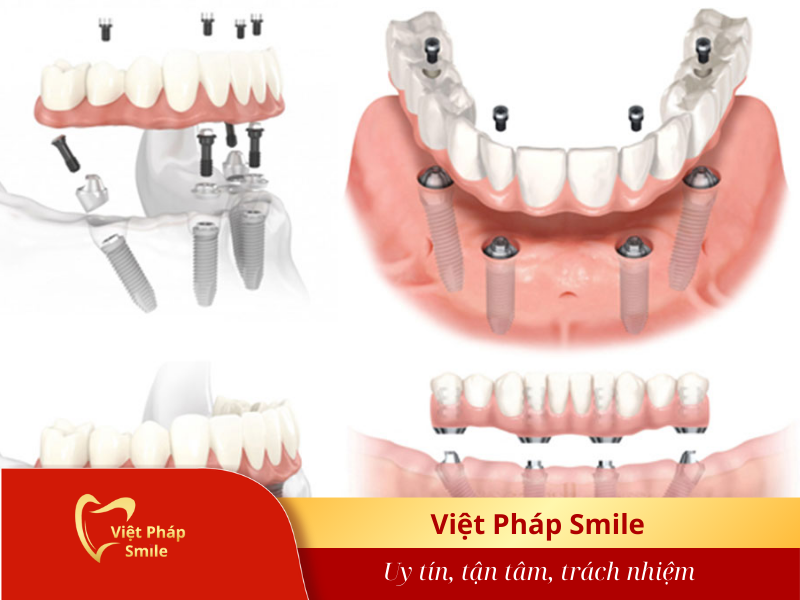 phuong-phap-trong-rang-implant-cho-mat-rang-toan-ham