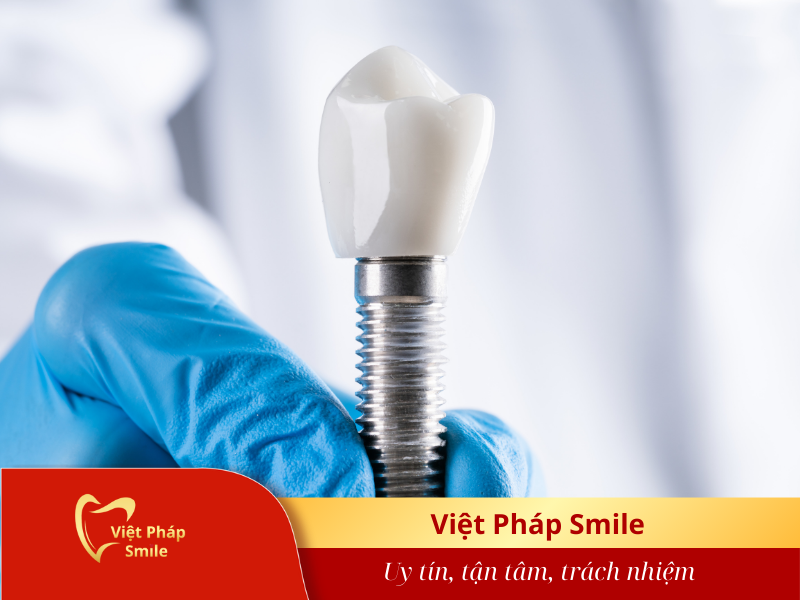 rang-implant-co-ben-khong