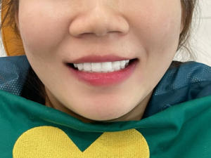 rang-su-co-de-bi-nut