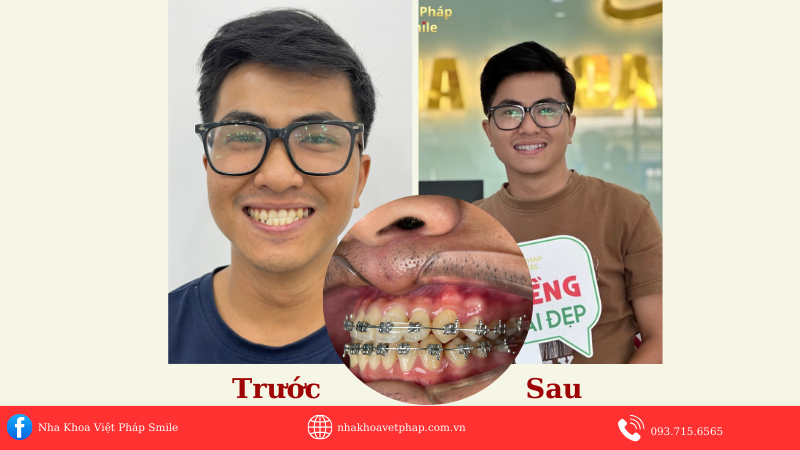 thay doi nu cuoi