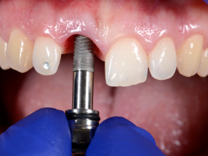 trieu-chung-cua-hien-tuong-dao-thai-implant