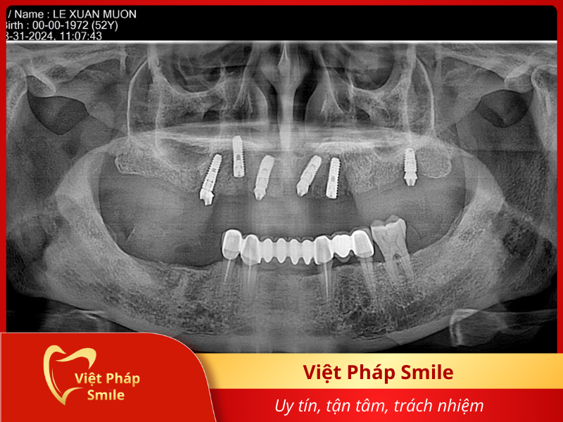 trong-rang-implant-1