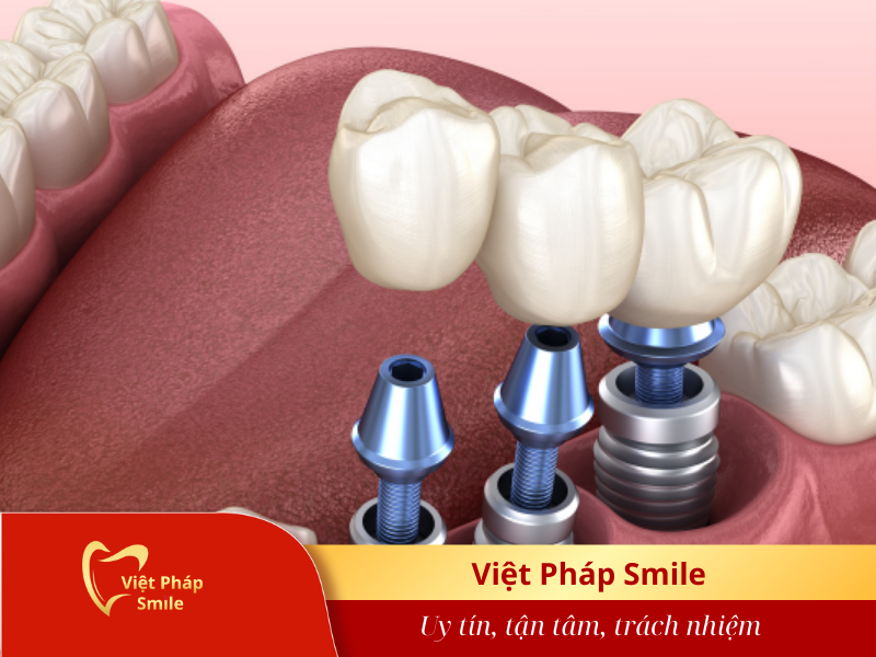trong-rang-implant-co-can-phai-thuc-hien-phau-thuat