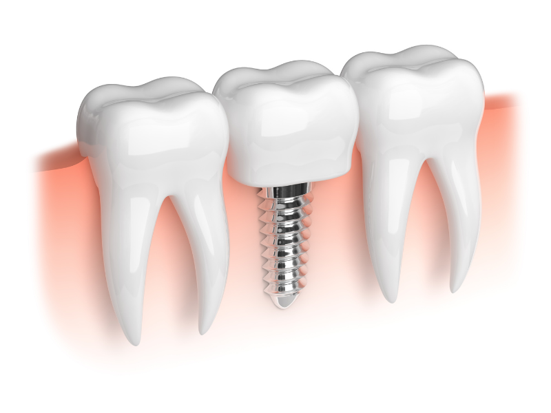 trong-rang-implant-co-dau-khong (1)