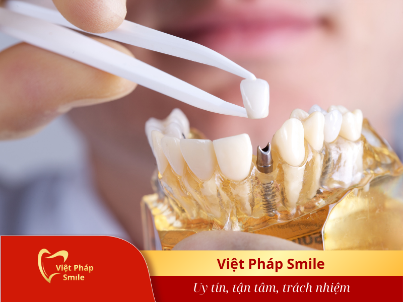 trong-rang-implant-co-nguy-co-dao-thai-hay-khong