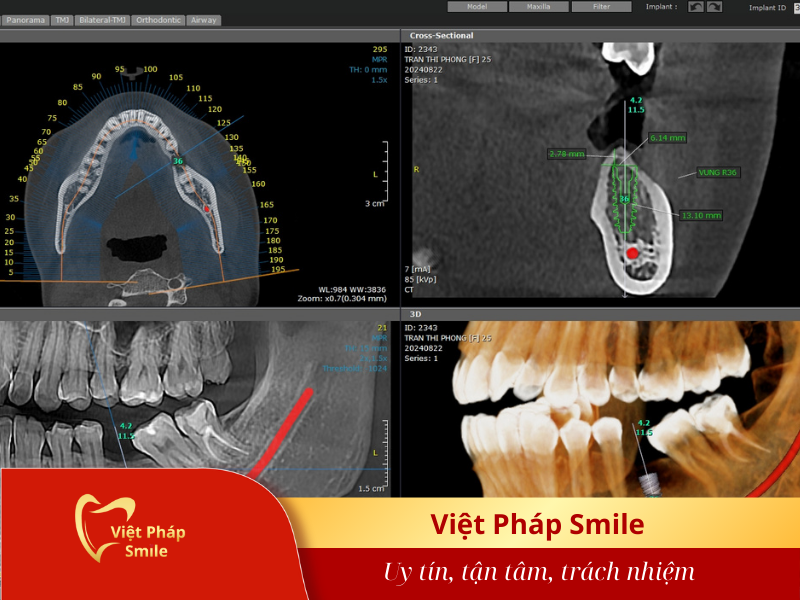 trong-rang-implant-co-yeu-cau-cham-soc-dac-biet-nao