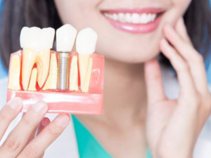 trong-rang-implant-lam-thay-doi-giong-noi