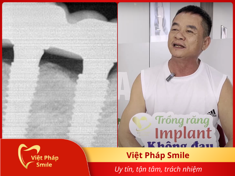 trong-rang-implant