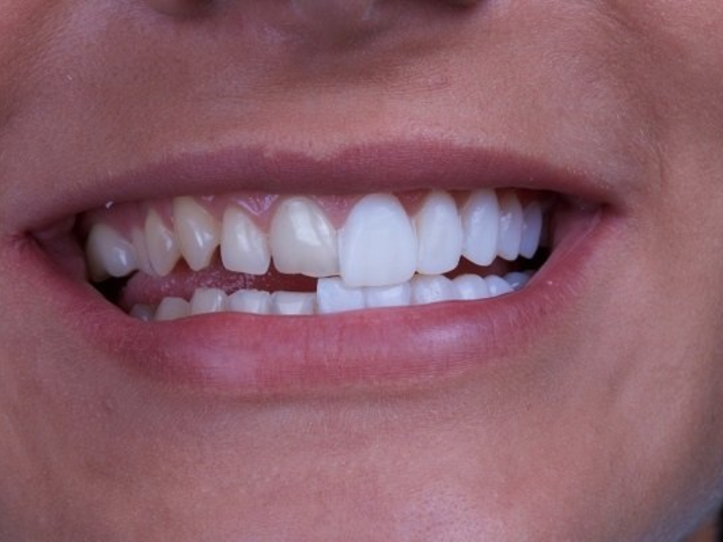 Dán sứ Veneer quận 12