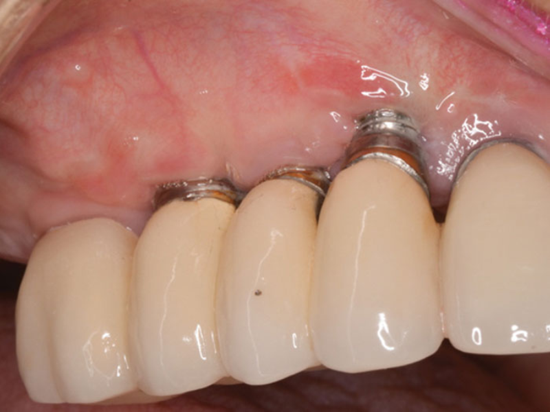 nguyen-nhan-tru-implant-bi-dao-thai