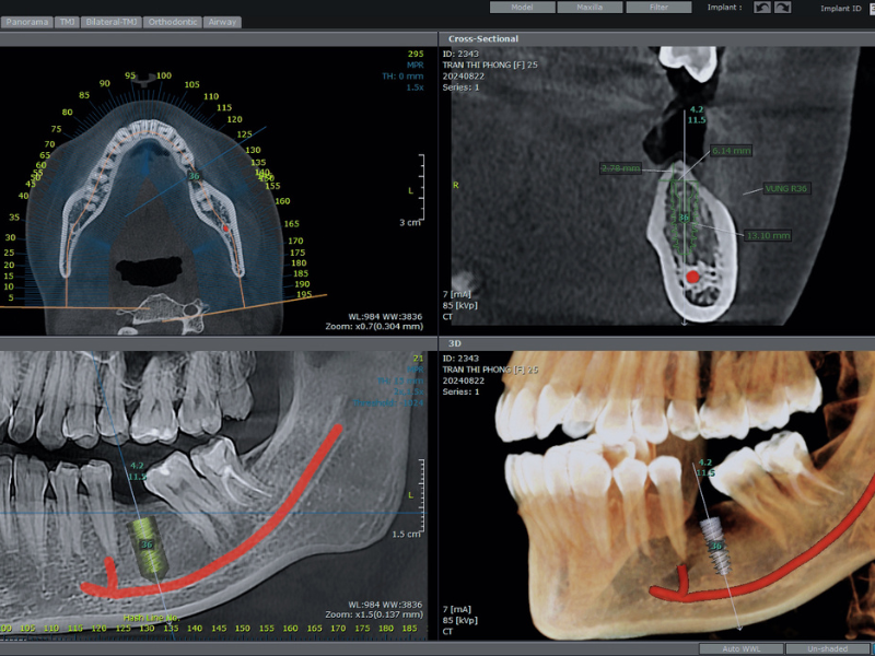 quy-trinh-trong-rang-implant-quan-12-khong-dau
