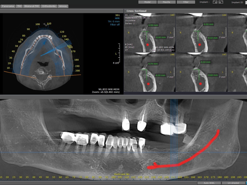 quy-trinh-cay-ghep-implant