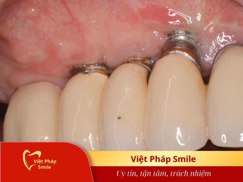 tru-implant-bi-dao-thai