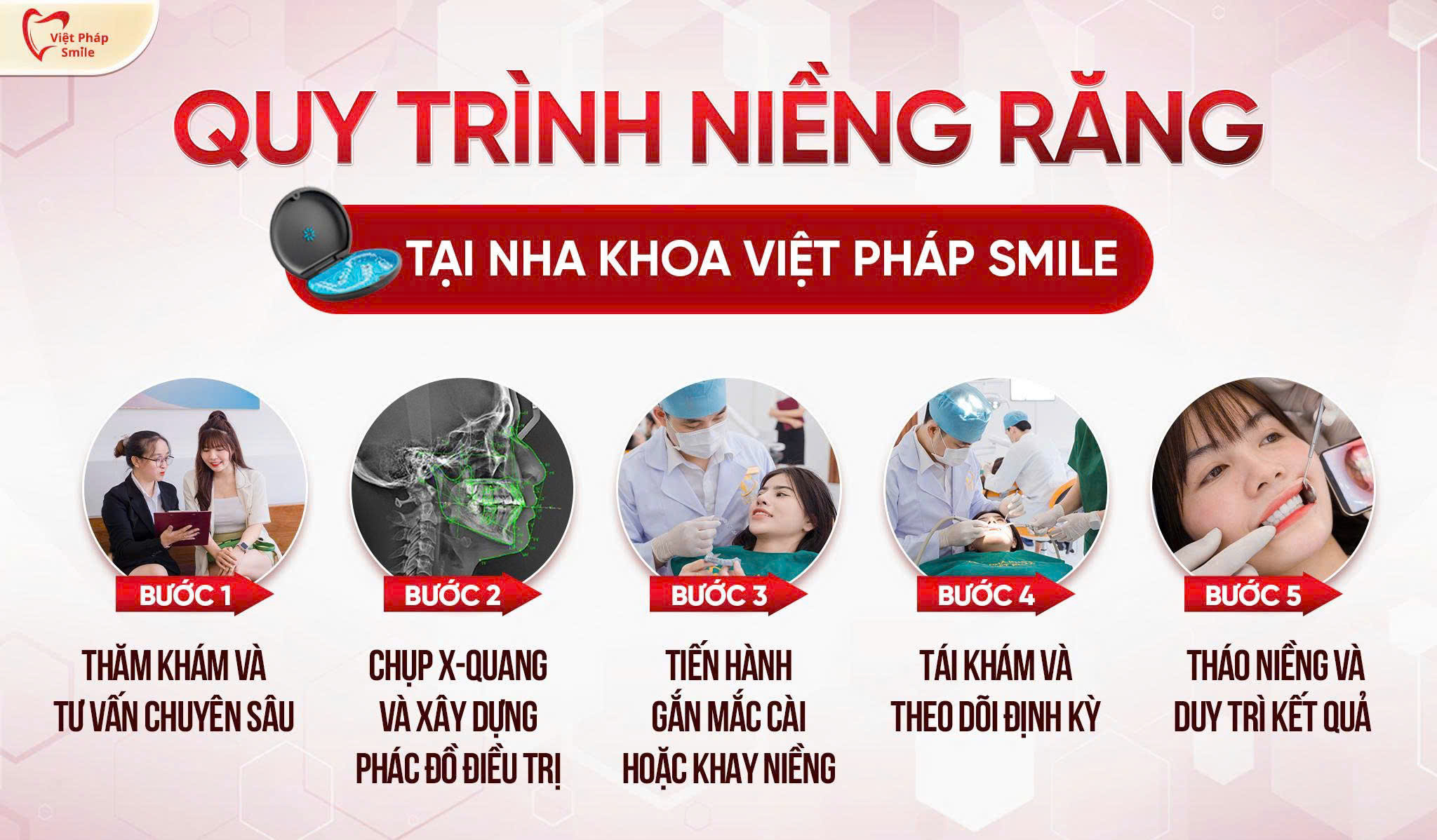Niềng răng giá bao nhiêu tại nha khoa quận 12 - Nha khoa niềng răng uy tín 12 Quy trình niềng răng tại Nha khoa Việt Pháp Smile