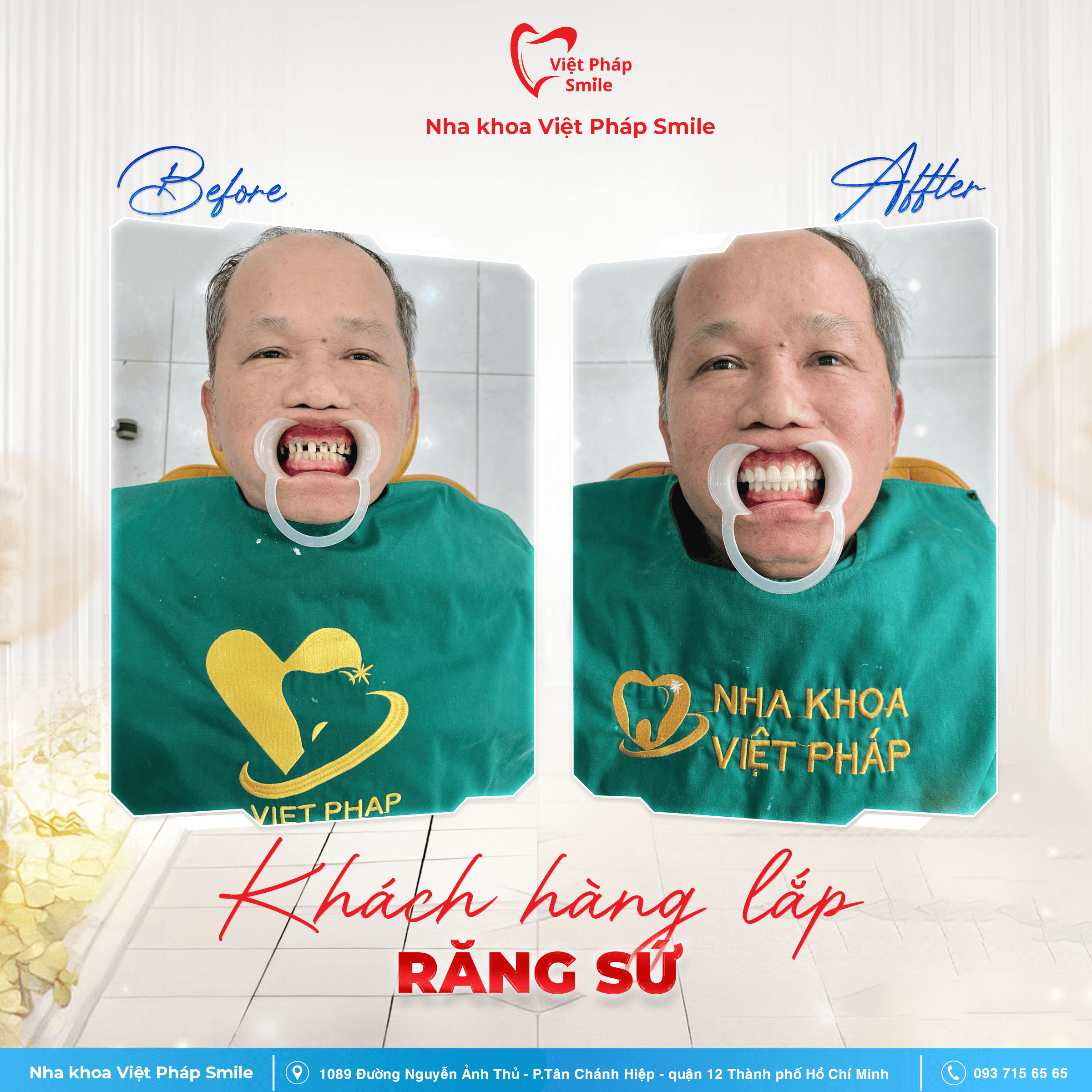 Bọc răng sứ thẩm mỹ 2