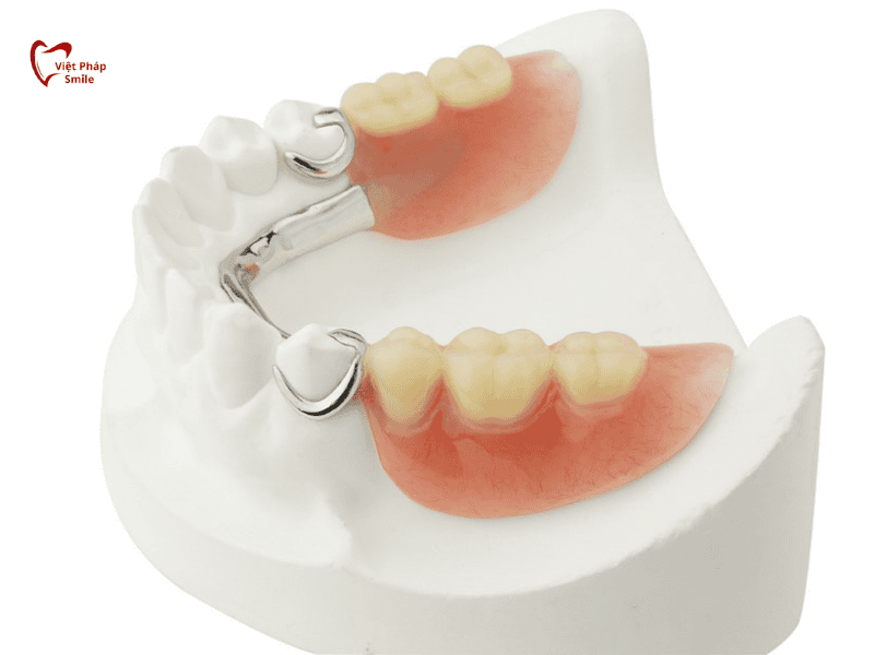 Hàm tháo lắp dạng Attachment (bán phần)