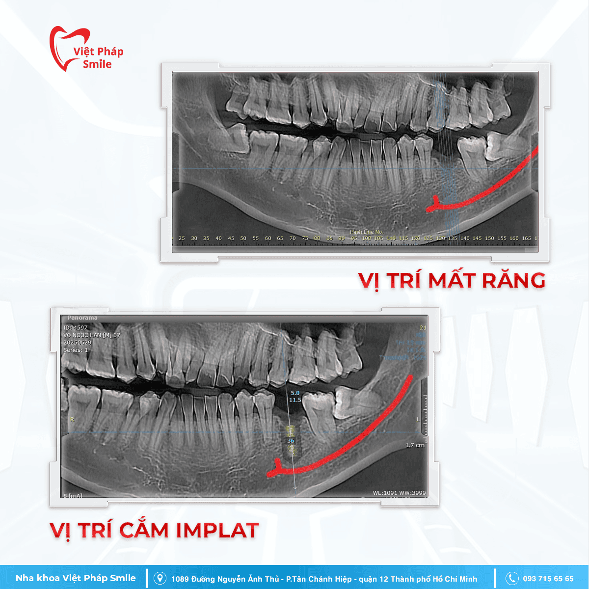 Teamplate BA 1