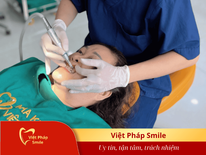 Trám răng thẩm mỹ tại Nha khoa Việt Pháp Smile 1