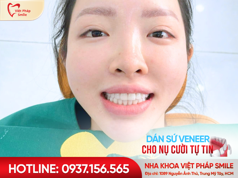 Dán sứ Veneer – Giải pháp thẩm mỹ không xâm lấn