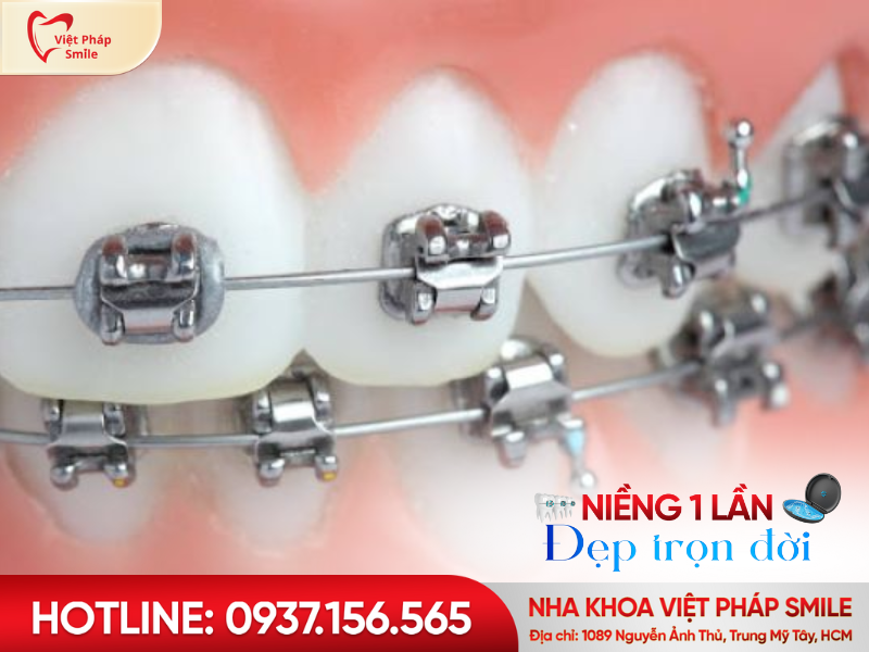 Niềng răng TP.HCM