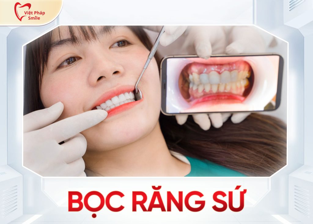 Bọc răng sứ phường Tam Bình – Giải pháp răng đẹp bền chắc cho cư dân địa phương 3 dich-vu-boc-su-tai-nha-khoa-viet-phap-smile