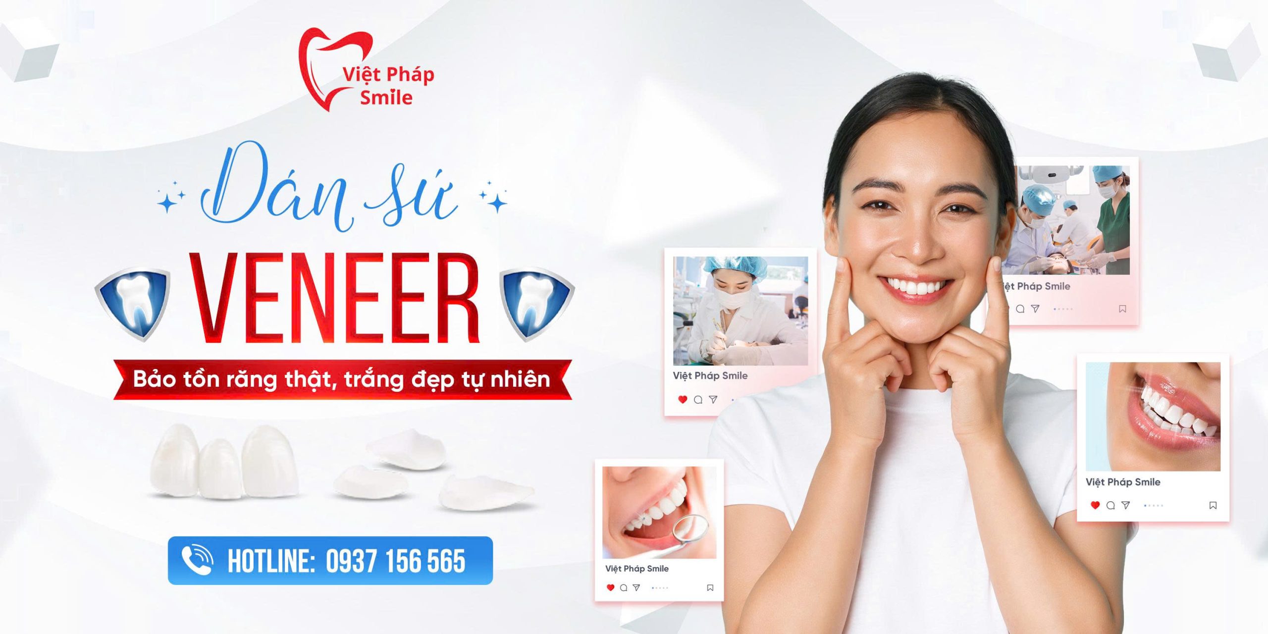 dich-vu-dan-veneer