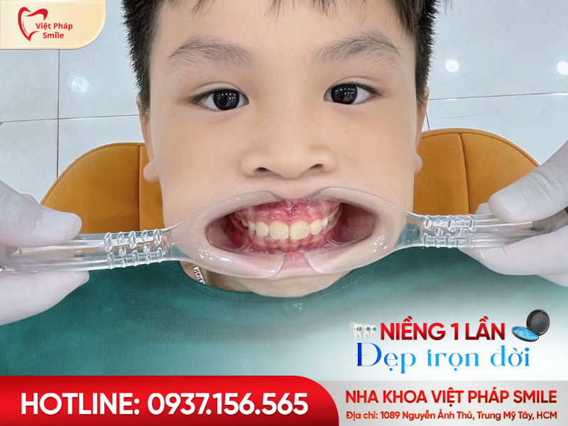 nieng rang tre em