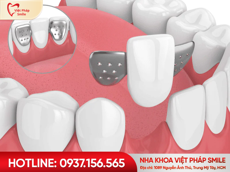 Cầu răng sứ cánh dán