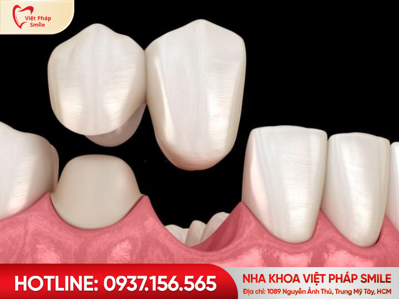 Cầu răng sứ nhờ một bên trụ (cầu răng đèo)