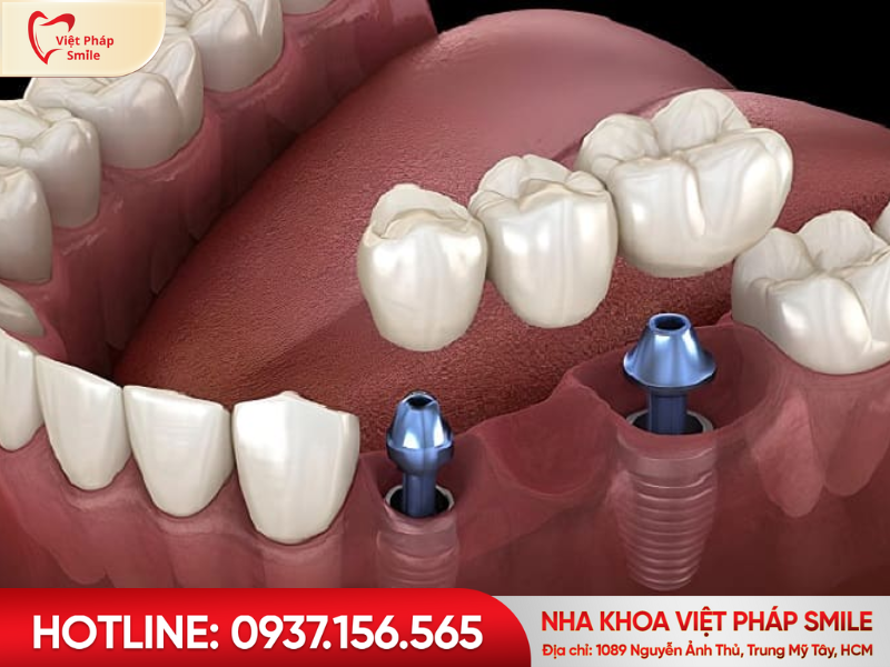 Cầu răng sứ trên trụ Implant