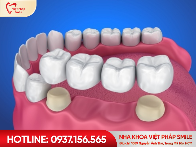 Cầu răng sứ truyền thống